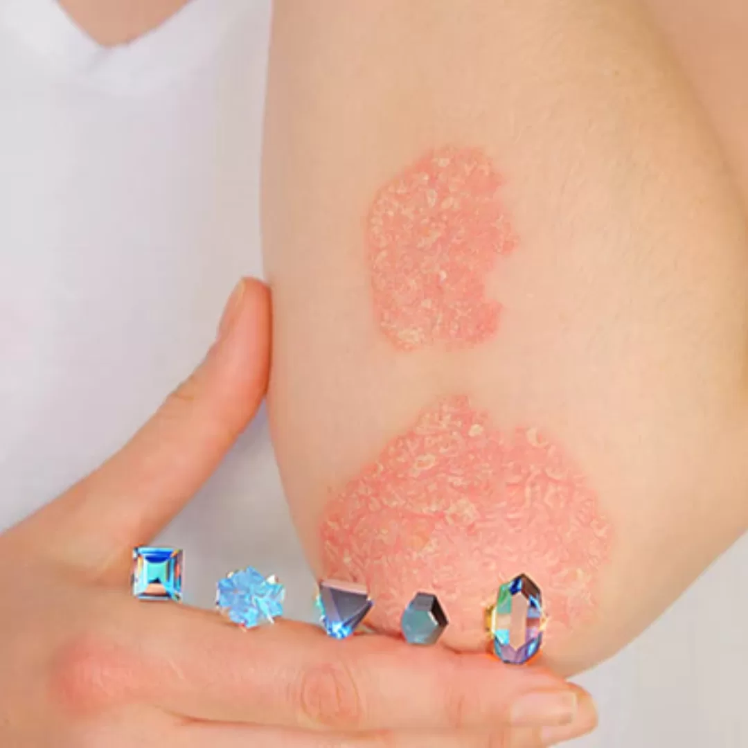 Crystals for Psoriasis