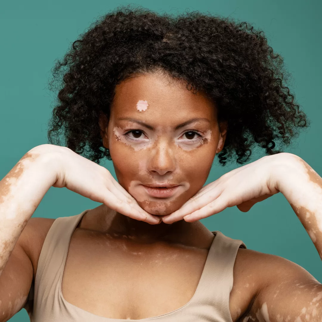 Spiritual Meaning of Vitiligo
