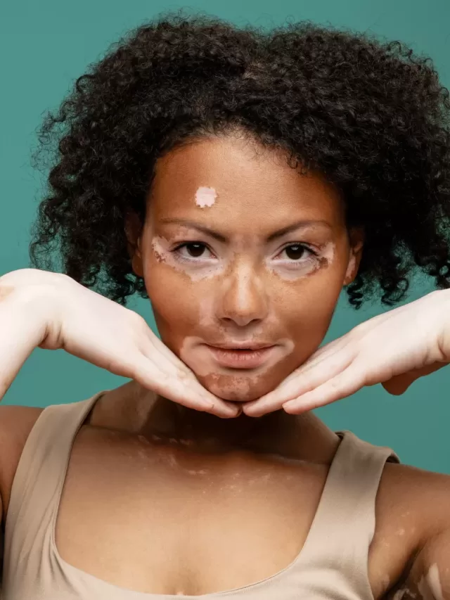 Spiritual Meaning of Vitiligo A Deep Dive into its Symbolism The